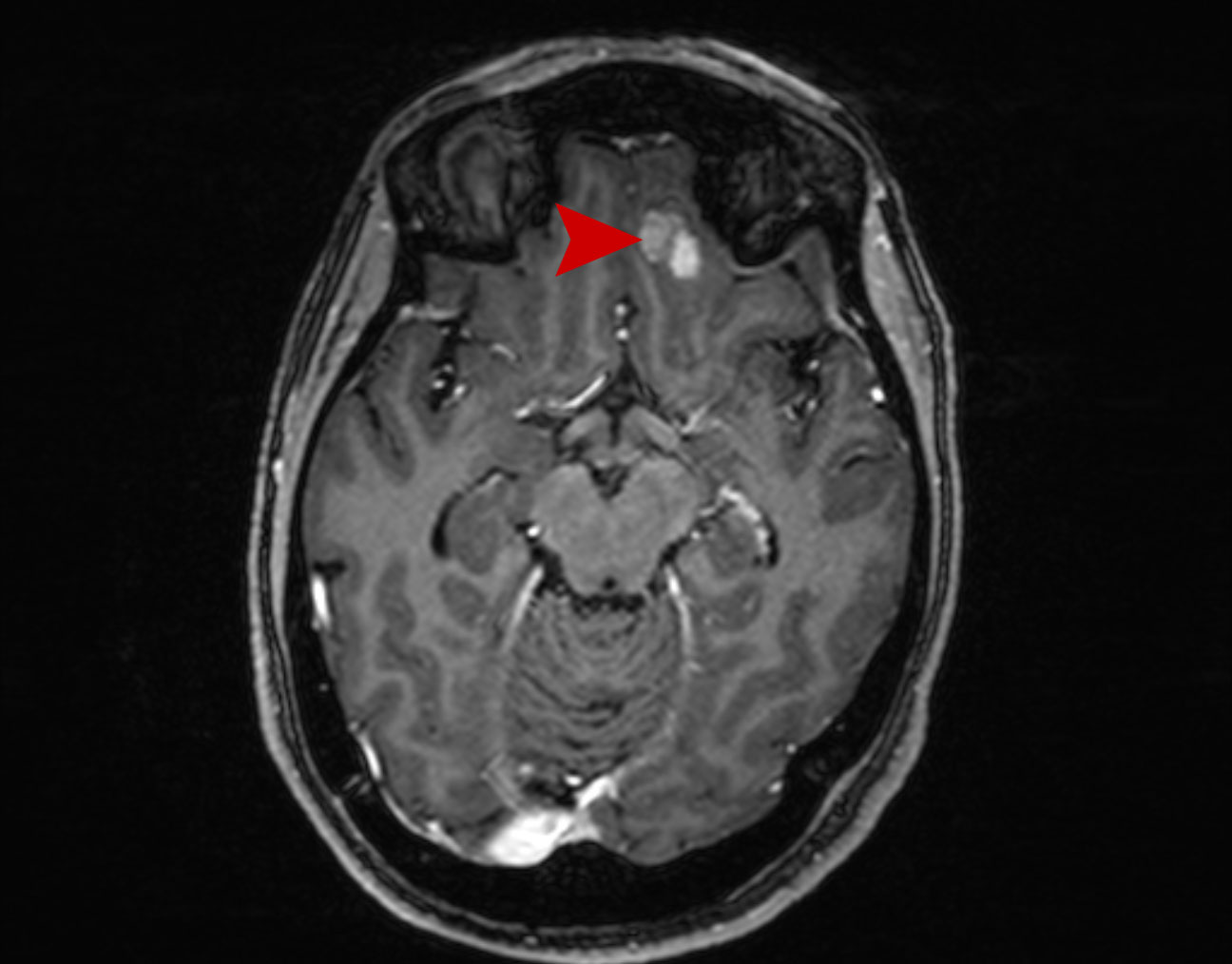 02a age 58 female brain meta melanoma 2016 10