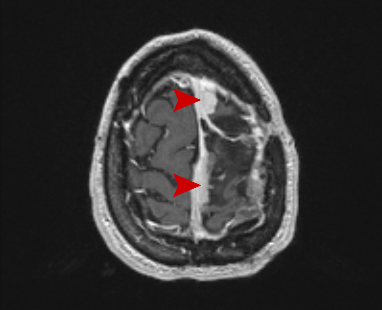 03a age 40 female minigioma grade ii 2018 06