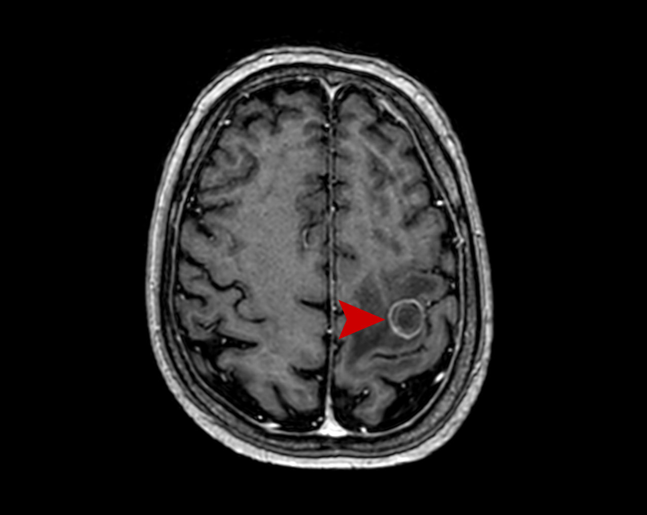 08a age 61 male meta lung cancer 2021 03