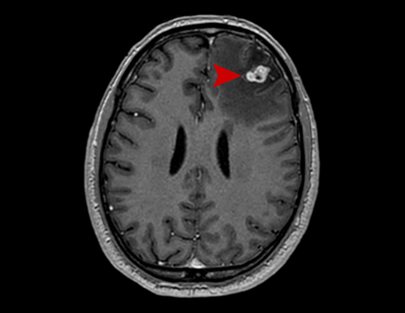 15a age 54 male lung cancer 2021 05