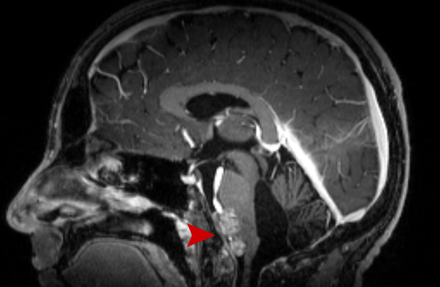 16a age 14 male recurent ependymoma 2020 12