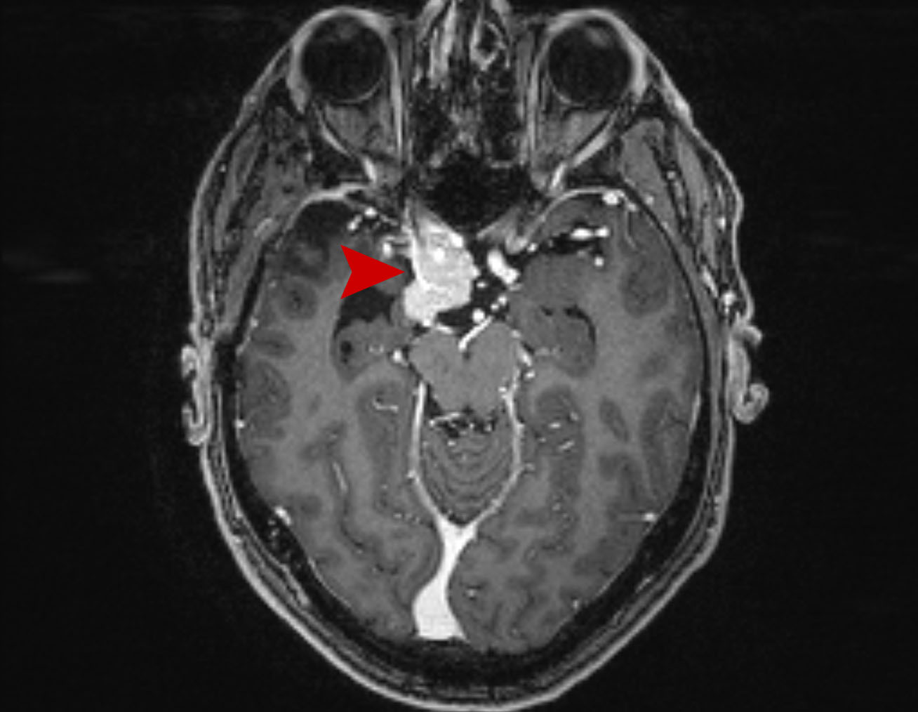21a age 46 male miniggioma 2020 02
