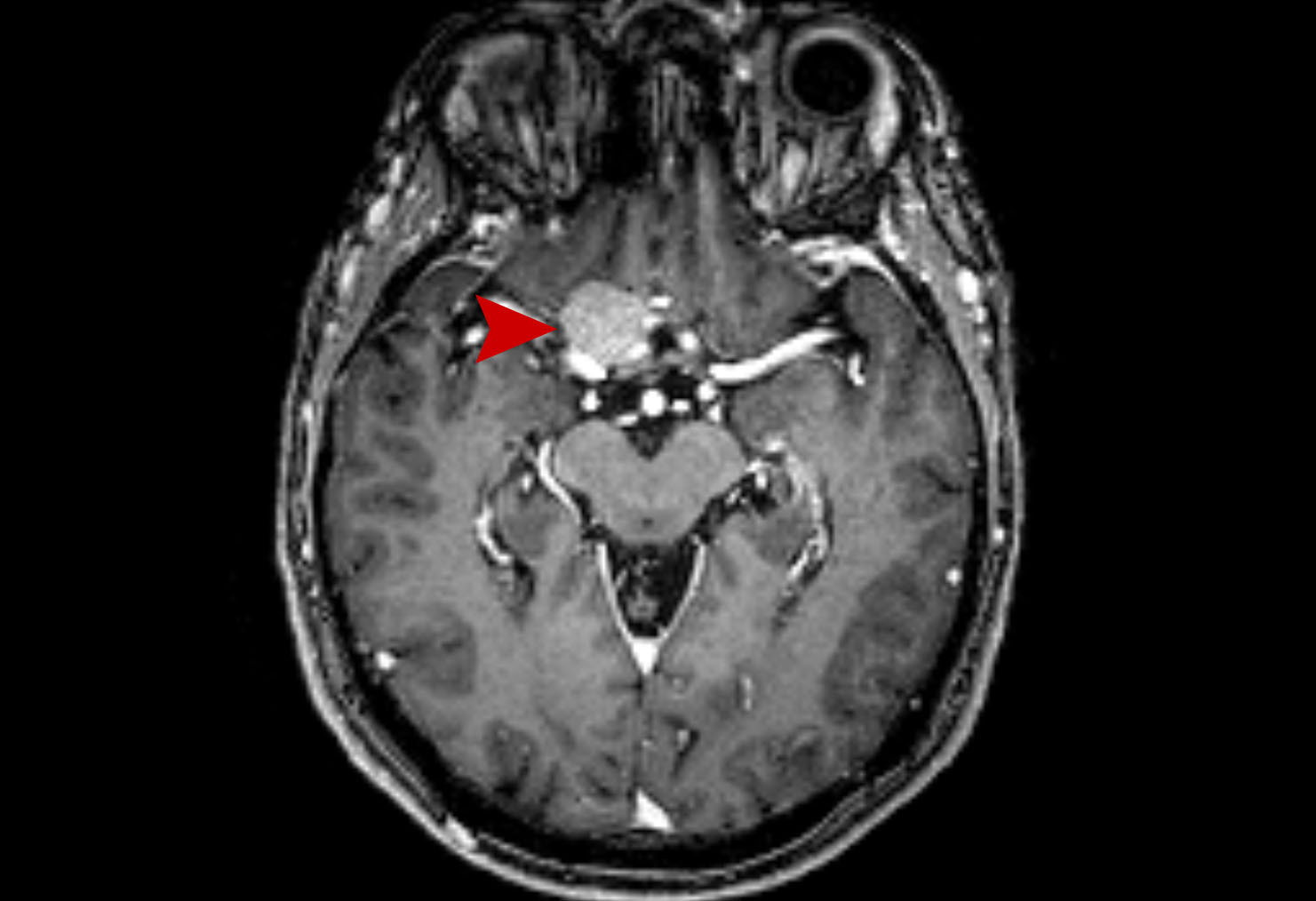 22a age 71 female miniggioma 2020 03