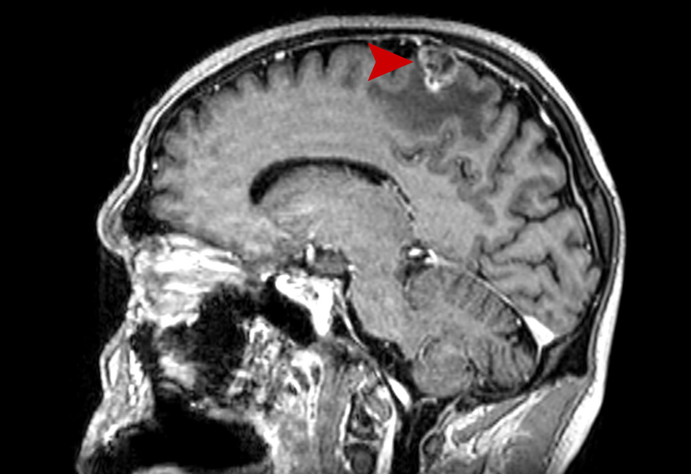 27a age 51 brain meta cancer lung 2021 01