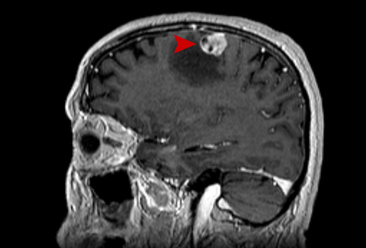 31a age 65 male brain metastasi 2017 03