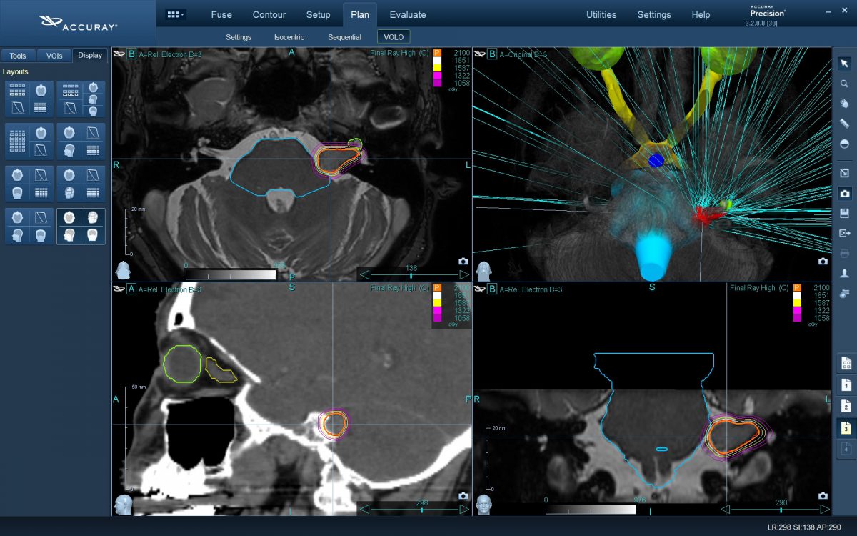 Ακουστικό Νευρίνωμα 002