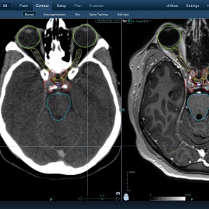 Αδένωμα Υπόφυσης 001 Θεραπεία με CyberKnife Αδένωμα Υπόφυσης 001 Θεραπεία με CyberKnife