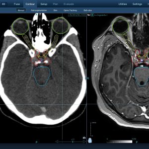Αδένωμα Υπόφυσης 001 Θεραπεία με CyberKnife Αδένωμα Υπόφυσης 001 Θεραπεία με CyberKnife