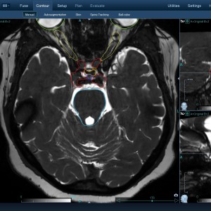 Αδένωμα Υπόφυσης 002 Θεραπεία με CyberKnife Αδένωμα Υπόφυσης 002 Θεραπεία με CyberKnife