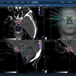 Αδένωμα Υπόφυσης 003 Θεραπεία με CyberKnife Αδένωμα Υπόφυσης 003 Θεραπεία με CyberKnife