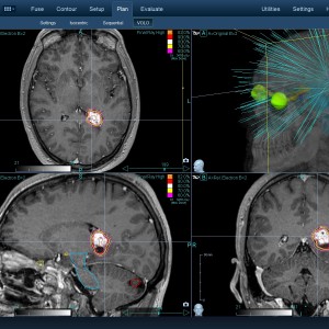 Αιμαγγειοβλάστωμα 001 Θεραπεία με CyberKnife Αιμαγγειοβλάστωμα 001 Θεραπεία με CyberKnife