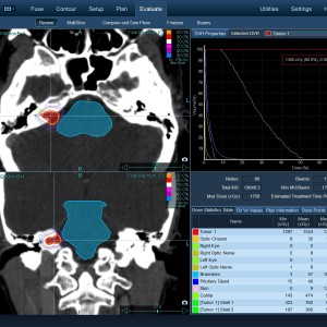 Ακουστικό Νευρίνωμα 001 Θεραπεία με CyberKnife Ακουστικό Νευρίνωμα 001 Θεραπεία με CyberKnife