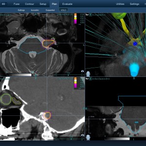 Ακουστικό Νευρίνωμα 002 Θεραπεία με CyberKnife Ακουστικό Νευρίνωμα 002 Θεραπεία με CyberKnife