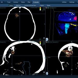 AVM 001 Θεραπεία με CyberKnife AVM 001 Θεραπεία με CyberKnife