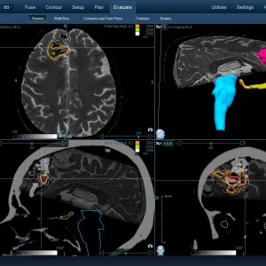 AVM 002 Θεραπεία με CyberKnife AVM 002 Θεραπεία με CyberKnife