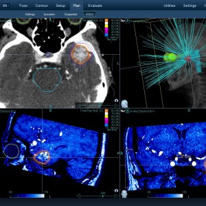 AVM 003 Θεραπεία με CyberKnife AVM 003 Θεραπεία με CyberKnife