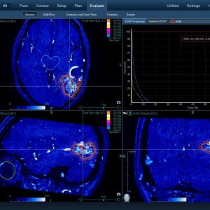 AVM 004 Θεραπεία με CyberKnife AVM 004 Θεραπεία με CyberKnife