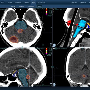 Επενδύμωμα 001 Θεραπεία με CyberKnife Επενδύμωμα 001 Θεραπεία με CyberKnife