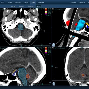 Επενδύμωμα 002 Θεραπεία με CyberKnife Επενδύμωμα 002 Θεραπεία με CyberKnife