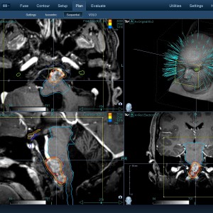 Επενδύμωμα 003 Θεραπεία με CyberKnife Επενδύμωμα 003 Θεραπεία με CyberKnife
