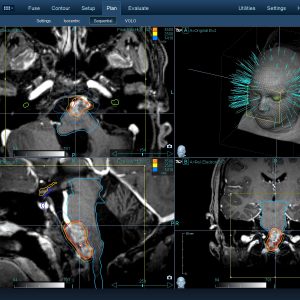 Επενδύμωμα 003 Θεραπεία με CyberKnife Επενδύμωμα 003 Θεραπεία με CyberKnife