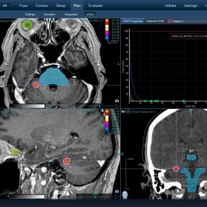 Μετάσταση Καρκίνος Πνεύμονα 001 Θεραπεία με CyberKnife Μετάσταση Καρκίνος Πνεύμονα 001 Θεραπεία με CyberKnife