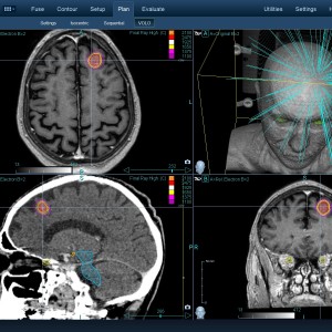 Μετάσταση Καρκίνος Πνεύμονα 002 Θεραπεία με CyberKnife Μετάσταση Καρκίνος Πνεύμονα 002 Θεραπεία με CyberKnife