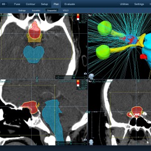 Μηνιγγίωμα 001 Θεραπεία με CyberKnife Μηνιγγίωμα 001 Θεραπεία με CyberKnife