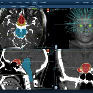 Μηνιγγίωμα 002 Θεραπεία με CyberKnife Μηνιγγίωμα 002 Θεραπεία με CyberKnife