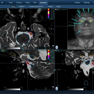 Νευραλγία Τριδύμου 001 Θεραπεία με CyberKnife Νευραλγία Τριδύμου 001 Θεραπεία με CyberKnife