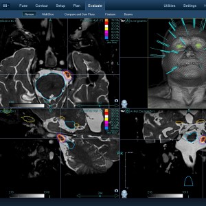 Νευραλγία Τριδύμου 001 Θεραπεία με CyberKnife Νευραλγία Τριδύμου 001 Θεραπεία με CyberKnife
