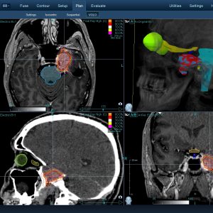 Νευραλγία Τριδύμου 002 Θεραπεία με CyberKnife Νευραλγία Τριδύμου 002 Θεραπεία με CyberKnife