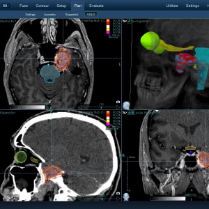 Νευραλγία Τριδύμου 002 Θεραπεία με CyberKnife Νευραλγία Τριδύμου 002 Θεραπεία με CyberKnife