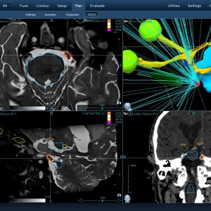 Νευραλγία Τριδύμου 003 Θεραπεία με CyberKnife Νευραλγία Τριδύμου 003 Θεραπεία με CyberKnife