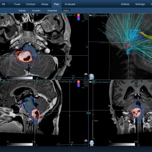 Νευρίνωμα 001 Θεραπεία με CyberKnife Νευρίνωμα 001 Θεραπεία με CyberKnife