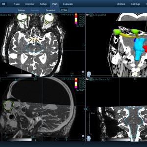 Νευρίνωμα 002 Θεραπεία με CyberKnife Νευρίνωμα 002 Θεραπεία με CyberKnife