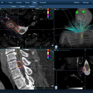 Νευρίνωμα AMSS 001 Θεραπεία με CyberKnife Νευρίνωμα AMSS 001 Θεραπεία με CyberKnife