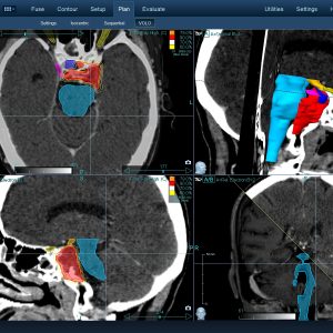 Χόρδωμα 001 Θεραπεία με CyberKnife Χόρδωμα 001 Θεραπεία με CyberKnife