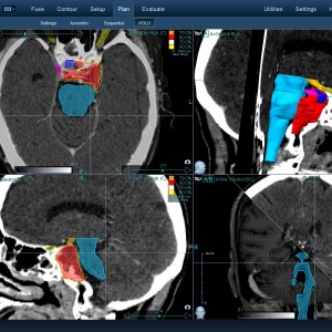 Χόρδωμα 001 Θεραπεία με CyberKnife Χόρδωμα 001 Θεραπεία με CyberKnife