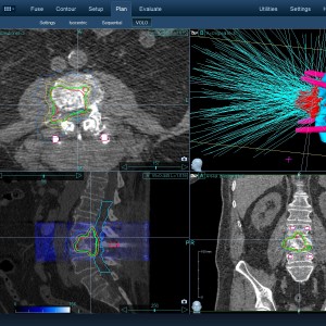 Χόρδωμα 002 Θεραπεία με CyberKnife Χόρδωμα 002 Θεραπεία με CyberKnife